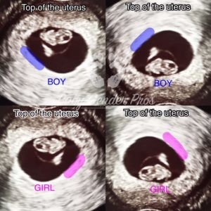 echo-ramzi-methode-Placenta-baby-jongen-meisje